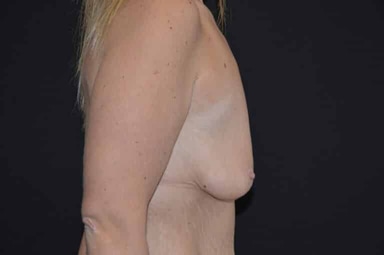 Breast lift with implants patient 18 before photo
