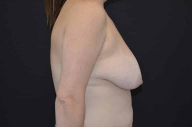 Breast lift with implants patient 27 before photo