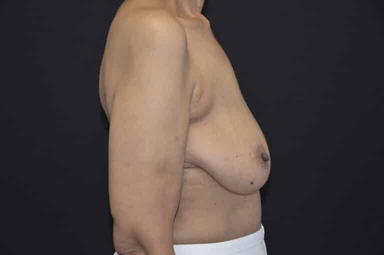 Breast lift with implants patient 7 before photo