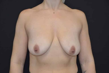 Breast lift with implants patient 28 before photo
