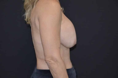 Breast lift with implants patient 29 before photo