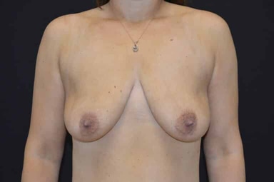 Breast lift with implants patient 21 before photo