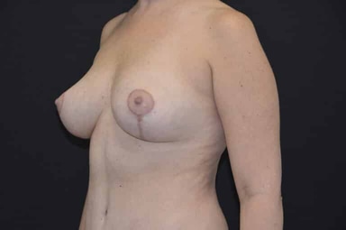 Breast lift with implants patient 22 after photo