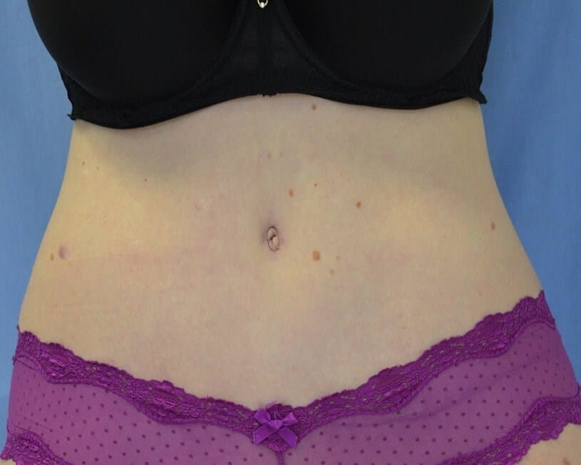 What are the hallmarks of a perfect Tummy Tuck?