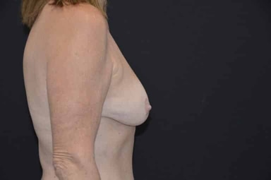 Breast lift with implants patient 27 before photo
