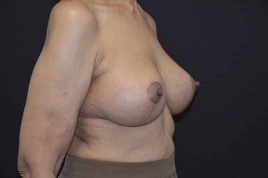 Breast lift with implants patient 7 after photo