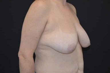 Breast lift with implants patient 27 before photo