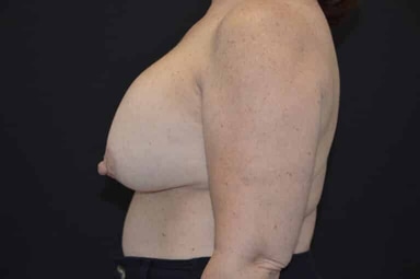 Breast lift with implants patient 4 before photo
