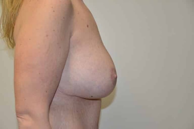 Breast lift with implants patient 18 after photo