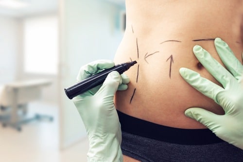 Liposuction Plastic Surgery Procedure Steps