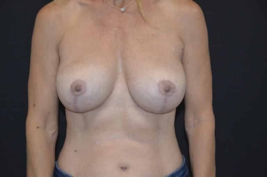 Breast lift with implants patient 29 after photo