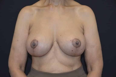 Breast lift with implants patient 7 after photo