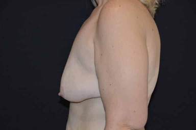 Breast lift with implants patient 15 before photo
