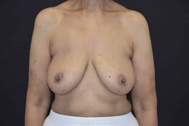 Breast lift with implants patient 7 before photo