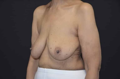 Breast lift with implants patient 7 before photo