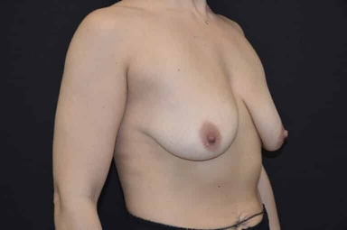 Breast lift with implants patient 28 before photo