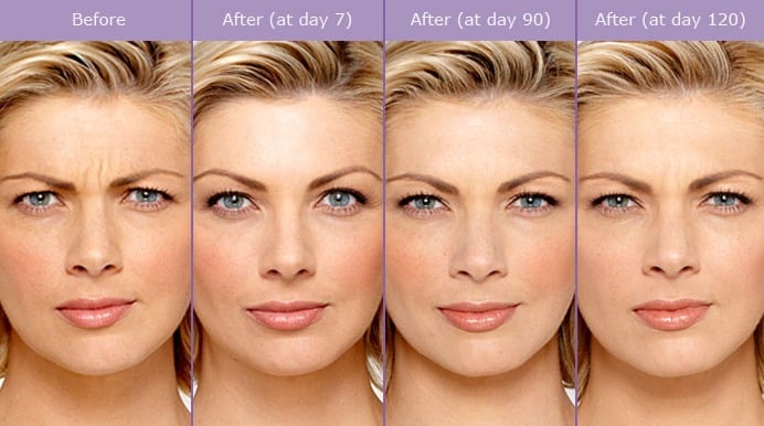 Botox Before And After Photos
