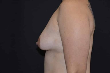 Breast lift with implants patient 24 before photo