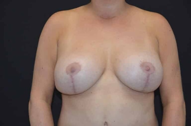 Breast lift with implants patient 27 after photo