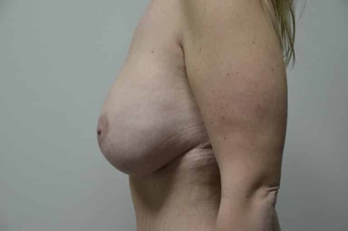 Breast lift with implants patient 18 after photo