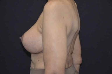 Breast lift with implants patient 7 after photo
