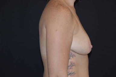 Breast lift with implants patient 25 before photo
