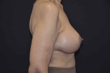 Breast lift with implants patient 7 after photo