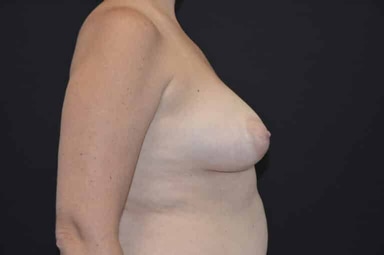 Breast lift with implants patient 22 before photo