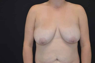 Breast lift with implants patient 27 before photo