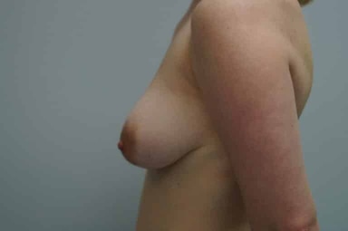 Breast lift with implants patient 26 before photo