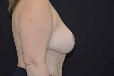 Breast lift with implants patient 32 after photo