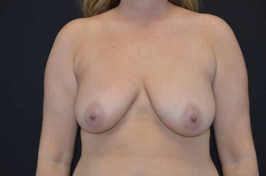Breast lift with implants patient 2 before photo