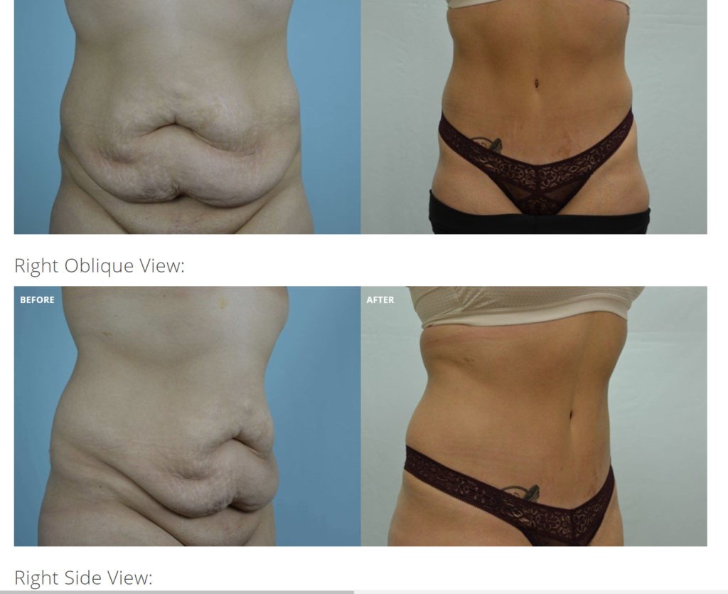 Perfect for Abdominoplasty or “tummy tuck”. Abdominoplasty or tummy tuck  is a cosmetic surgery procedure used to make the abdomen…