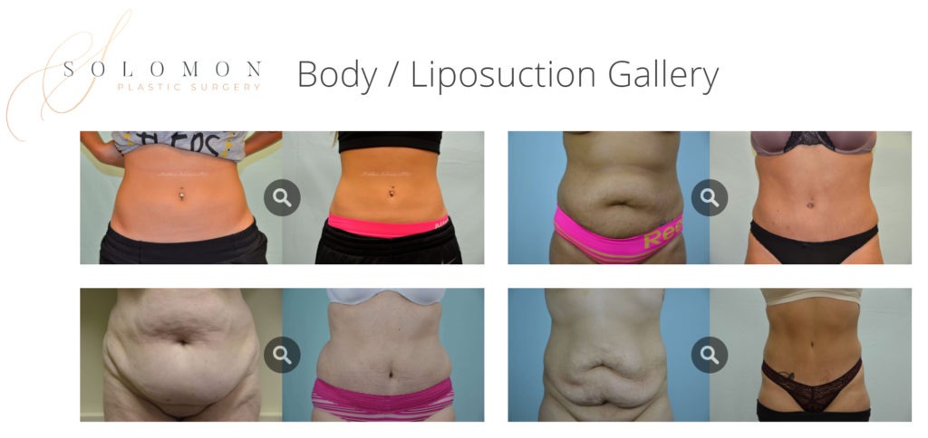 Liposuction Abs