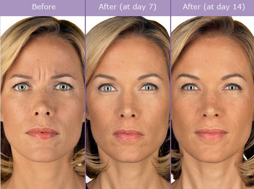 Botox Before And After Photos