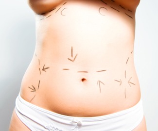 Are You A Candidate For Liposuction Surgery?