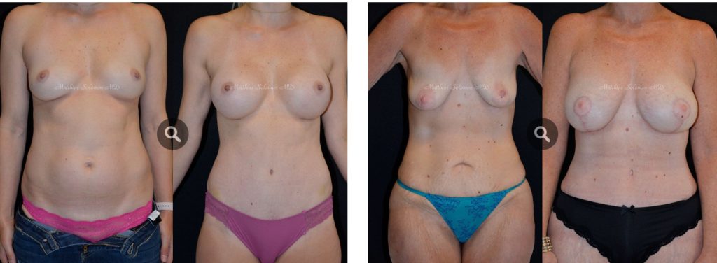 Body Contouring Plastic Surgery Before And After Photos