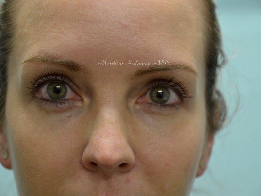 After Image: Lower/Upper Blepharoplasty - front