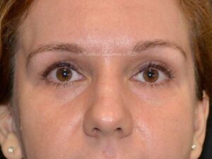 Before Image: Fat Grafting