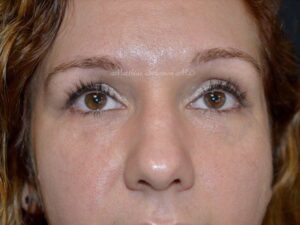 After Image: Fat Grafting