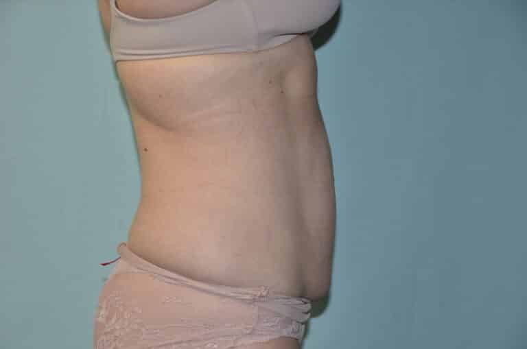 Before Image: Tummy Tuck - right-side