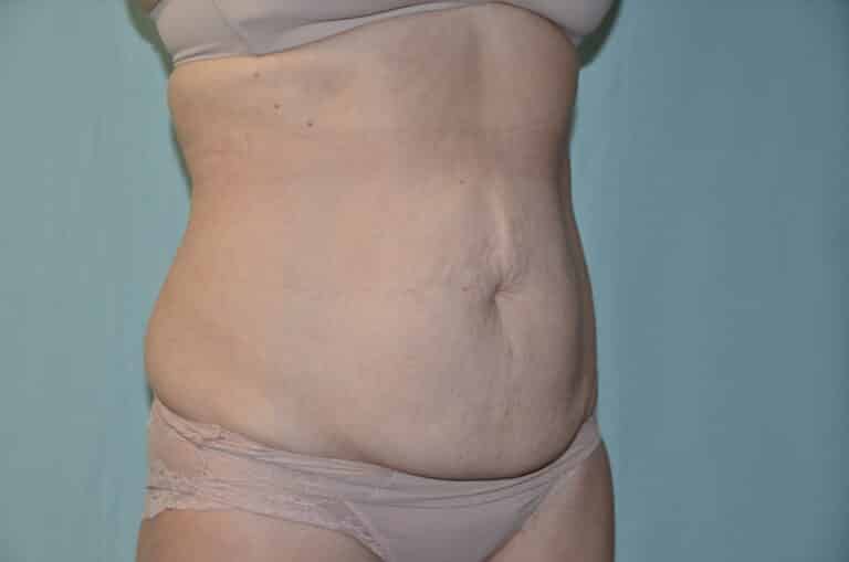 Before Image: Tummy Tuck - right-front-oblique