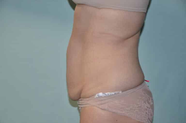 Before Image: Tummy Tuck - left-side