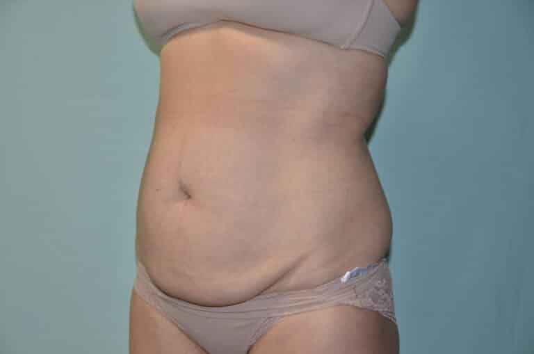 Before Image: Tummy Tuck - left-front-oblique