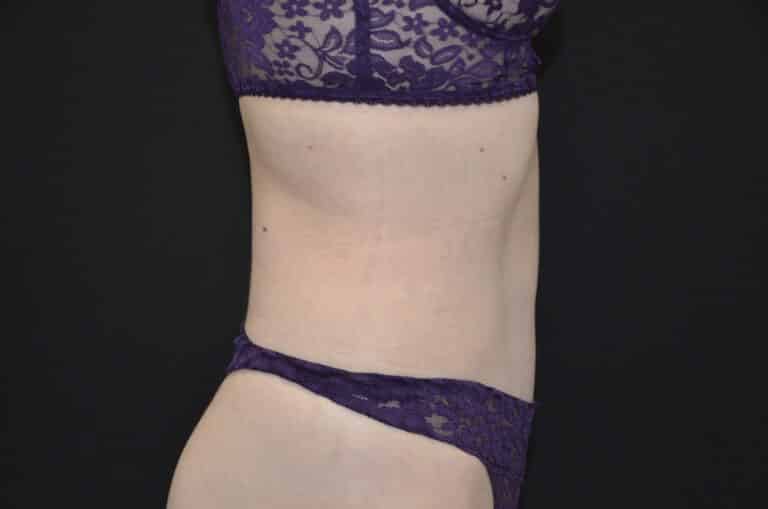 After Image: Tummy Tuck - right-side