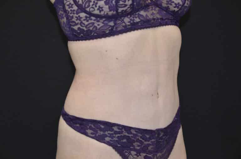 After Image: Tummy Tuck - right-front-oblique