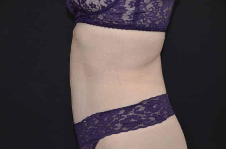 After Image: Tummy Tuck - left-side