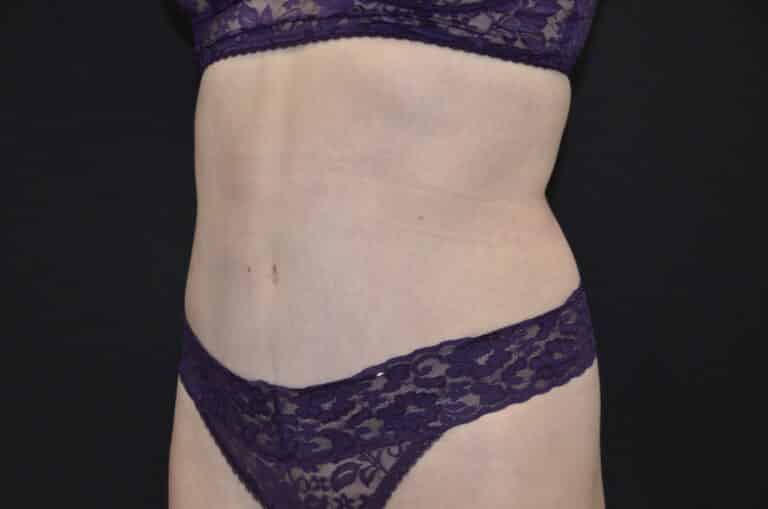 After Image: Tummy Tuck - left-front-oblique