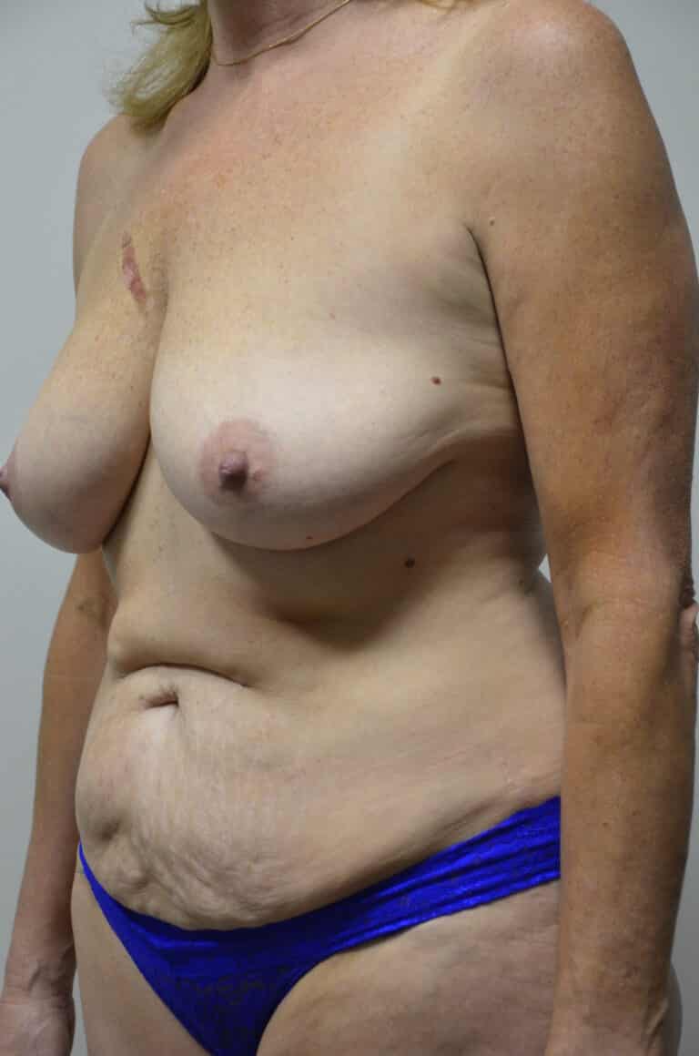 Before Image: Mommy Makeover - left-front-oblique