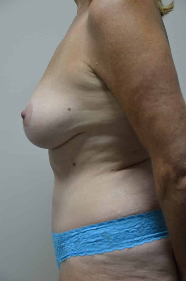 After Image: Mommy Makeover - left-side